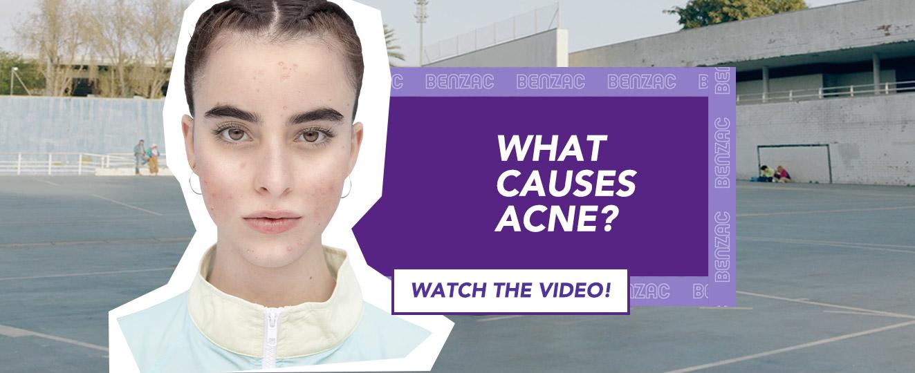 Video Cover What causes Acne